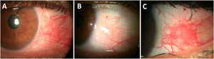 Episcleritis in patients with early diagnosis of Rheumatoid Arthritis. (A) Acute simple episcleritis on the temporal quadrant of the left eye showing superficial ingurgitated vessels of the episcleral plexus. (B) Same eye after 3min of 5% phenylephrine eye drop instillation, showing significant vessel blanching. (C) Active recurrent nodular episcleritis in a young patient with unknown RA.