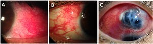 Scleritis in patients with longstanding Rheumatoid Arthritis. (A) Anterior diffuse scleritis on the temporal quadrant of the left eye showing deep dilated vessels with scleral edema. (B) Active nodular scleritis in the superior temporal area of the right eye. (C) Extensive necrotizing scleritis with significant uveal bulge surrounded by ischemic sclera and deep scleral vasculature ingurgitation.