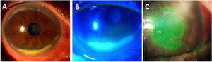 Corneal ulceration associated with Rheumatoid Arthritis (RA). (A) Peripheral ulcerative keratitis in an RA patient with associated Sjögren syndrome, showing a dense inferior peripheral circumferential stromal infiltrate. (B) Positive fluorescein staining of the same eye showing an extensive epithelial defect. (C) Central corneal ulceration (positive fluorescein staining) in an aged woman with a long history of uncontrolled RA.