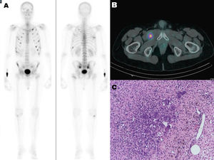 A) Bone scan with multiple fractures: rib, bony pelvis and left proximal femur. B) SPECT-CT scan with octreotide-Tc99m showing right inguinal mesenchymal tumour with somatostatin receptor type 2. C) Histological section of the mesenchymal tumour (haematoxylin-eosin stain) with multinucleated osteoclast-like giant cells and haemosiderin deposits (haemosiderophages).
