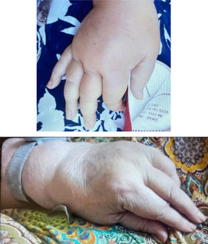 ‘Boxing glove’ oedema.