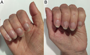 Horizontal blue-gray subungual bands on the fingernails.