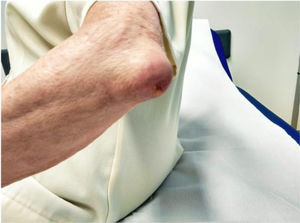 Chronic olecranon bursitis on the left side. Note the fistulous tract with active drainage.