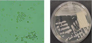 Images courtesy of the microbiology department of the HUCA. On the left is a direct microscopic examination showing microorganisms in a characteristic "morula" or "spoke-and-wheel" arrangement. On the right is the growth of the bursal fluid sample in Sabouraud culture medium (typically used as a fungal enrichment medium).
