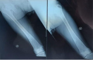 Femur X-ray in a Gaucher disease patient revealing Erlenmeyer flask shape.