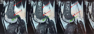 Magnetic resonance imaging of the femur in a patient with Gaucher disease. Extensive cellular infiltration involves the visible part of the diaphysis, the metaphysis, and a portion of the femoral epiphysis, indicated by a low signal intensity in these areas (red arrow). Normal bone marrow appears as a high signal intensity (green arrow).