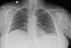 Chest X-ray: osteosclerotic lesions in both humeral heads.