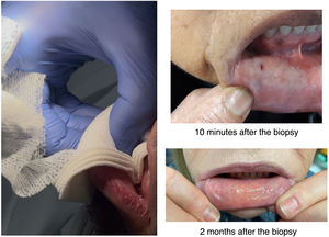 Minimal incision technique: haemostasis and final result.