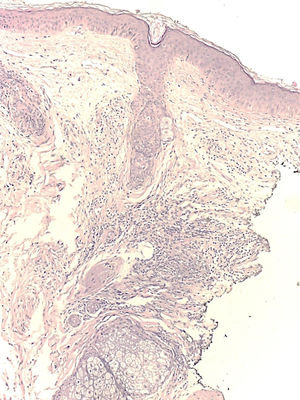 Histological section of a cutaneous lozenge with a predominantly lymphohistiocytic inflammatory process with perivascular and perianexal distribution in the mid and deep dermis. Hematoxylin and eosin, 100×.