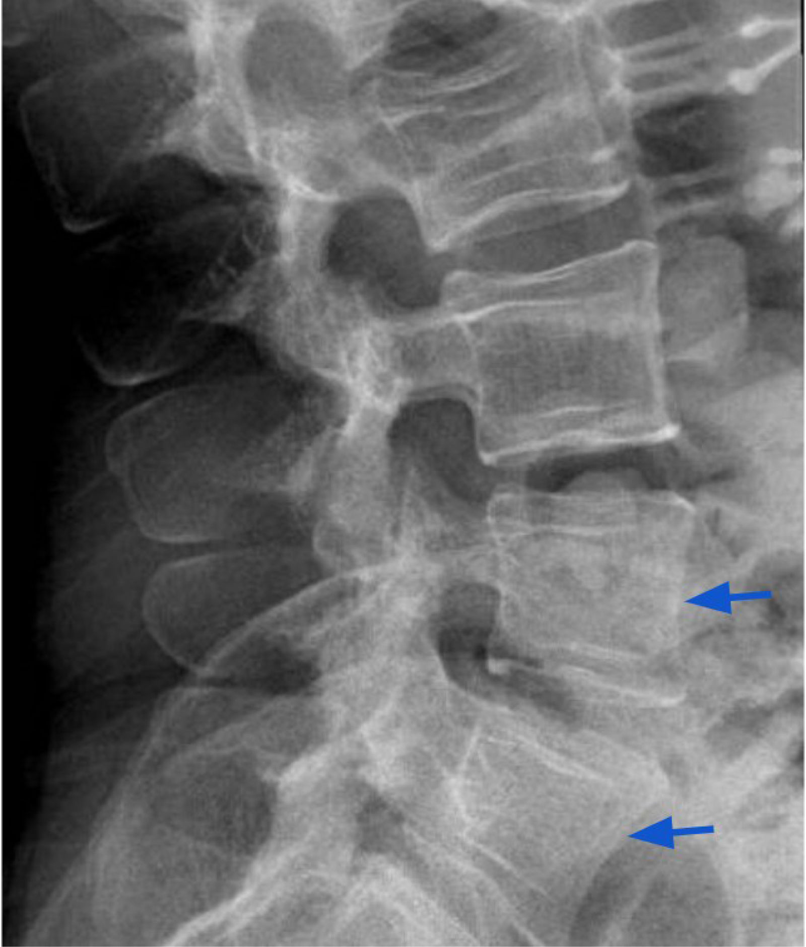 Vertebral “bone-within-bone” appearance after childhood bisphosphonate ...