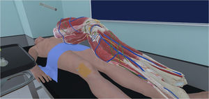 3D anatomical representation of the area where we must perform the arthrocentesis.