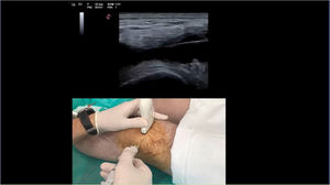 Visualisation of the ultrasound-guided arthrocentesis. On the screen you can see an image of knee arthrocentesis and at the same time the ultrasound image.