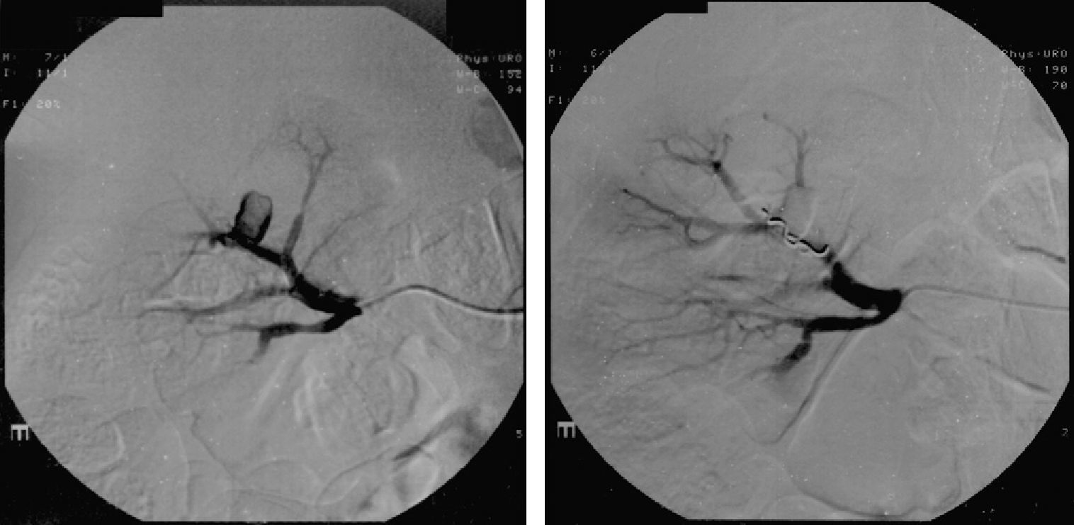 Delayed bleeding after partial nephrectomy management with selective