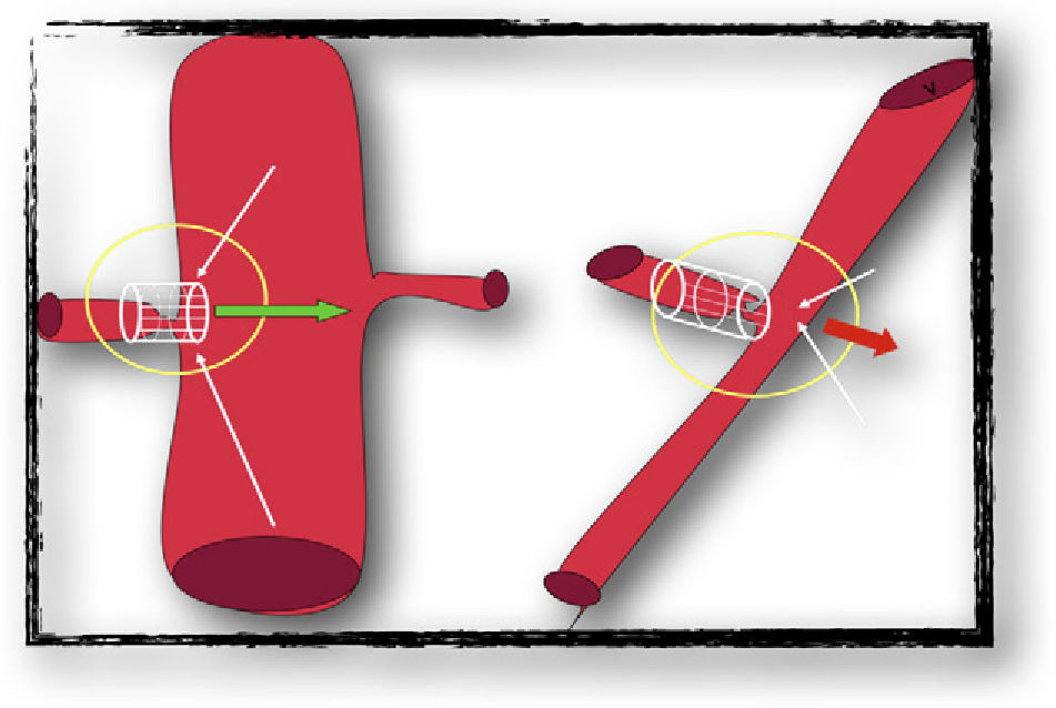 Endovascular treatment of stenosis of the renal artery in transplanted ...