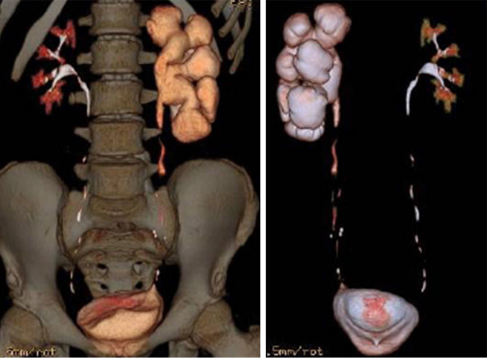 totally-laparoscopic-repair-of-primary-obstructive-megaureter-with