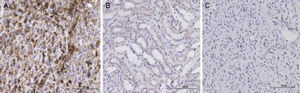 Immunohistochemical expression of MICA in renal cell carcinoma and normal renal tissues. (A) Representative of renal cell carcinoma, which strongly expressed MICA in cytoplasm and cytomembrane. (B) Normal renal tissue, which showed a limited expression in cytomembrane. (C) A negative control (scale bar: 100μm).