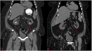 A. Patient with uric acid stones on CT-KUB (see arrows) before treatment with potassium citrate oral dissolution therapy. B. Same patient with no residual stones on low dose CT-KUB (see arrows) after course of oral dissolution therapy.