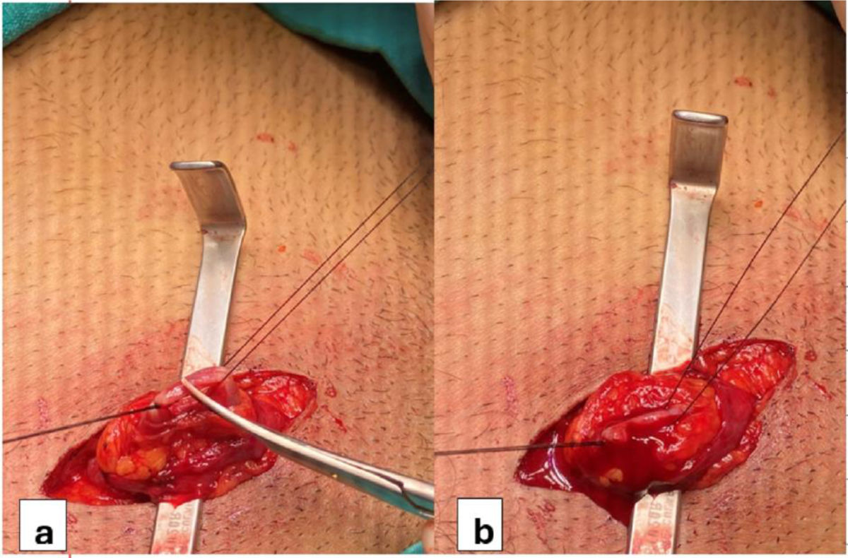 Drainage of varicose veins during subinguinal microscopic ...