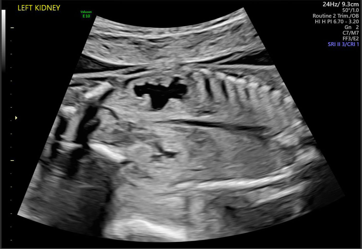 Calrectasis Prenatal ultrasonographic evaluation and management of renal and ...