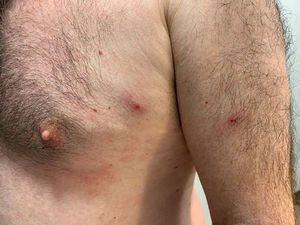 Blistering, pustular and ulcerated lesions on buttocks, chest and scalp.