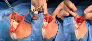 (a) Marking the dimensions of the BMG with a surgical pen. (b) Initial incision and elevation of the BMG. (c) Completed harvesting of the BMG.