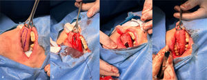 (a) Marking the dimensions of the SIMG with a surgical pen. (b) Initial Incision and elevation of the SIMG. (c) Closing of the SIMG with the running suture. (d) Completed harvesting of the SIMG.