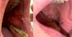 (a) Primary suturing of the BMG harvest site for effective bleeding control and accelerated wound healing. (b) Secondary healing of the BMG harvest site to alleviate oral pain and facilitate mouth opening.