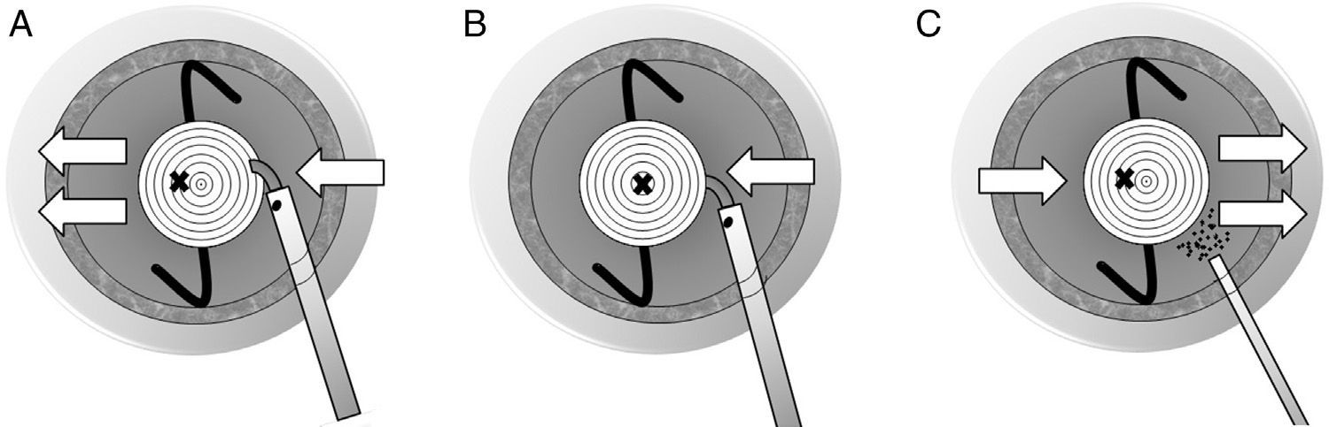 Surgical technique for centering diffractive intraocular lenses with ...