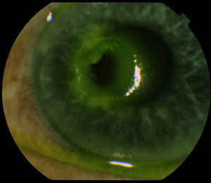Left eye corneal perforation. Air bubble in anterior chamber.