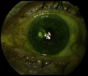 Fully closed corneal perforation. Image taken 3 months after surgery.