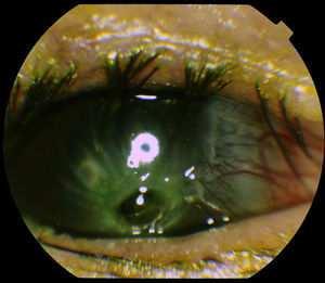 Inferior corneal perforation.