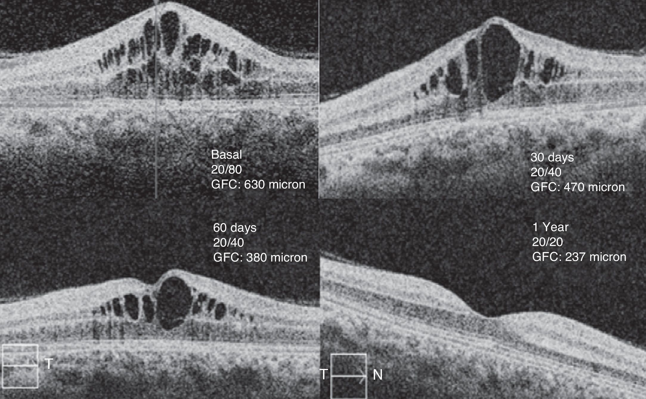 Intravitreal bevacizumab in the treatment of idiopathic juxtafoveal ...