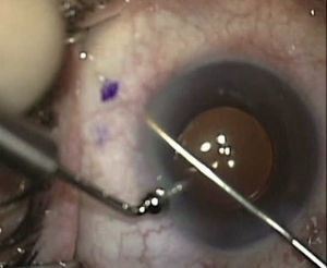 Maneuver for implanting the XEN device in the superior and nasal area from the opposite quadrant with the injector, exerting counterpressure with the Vera hook through the paracentesis.