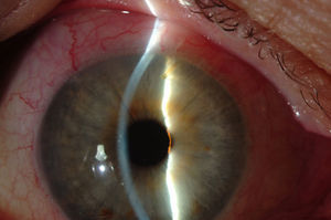 Postoperative appearance of the XEN device in the anterior chamber.