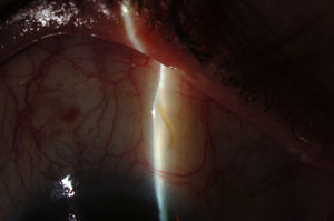 Postoperative appearance of the subconjunctival pathway of XEN, showing diffuse and posterior bleb.
