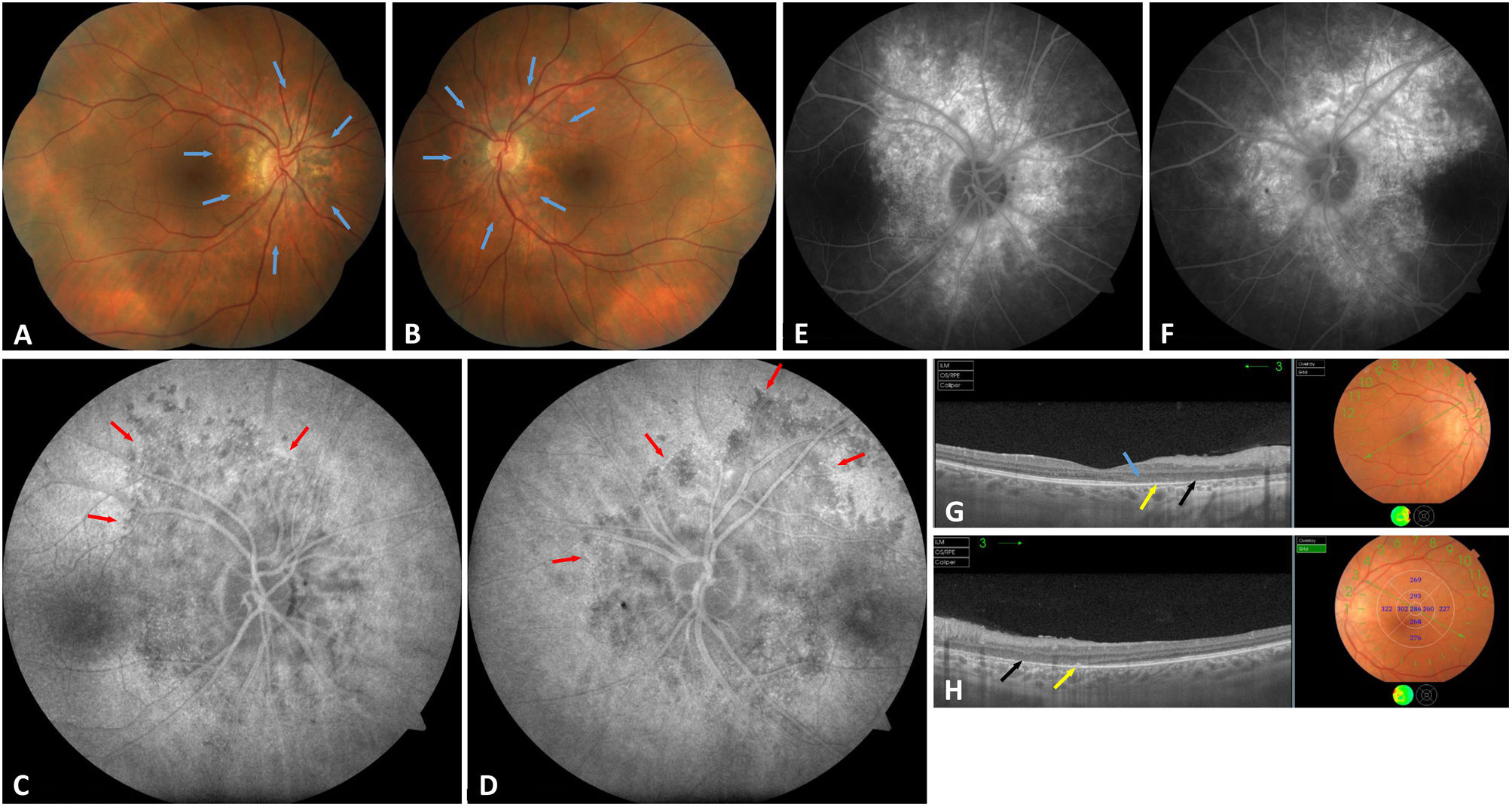 Two case reports of acute zonal occult outer retinopathy (AZOOR ...