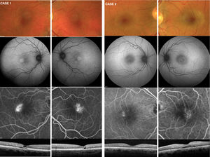Initial presentation of the 2 patients at the time of diagnosis of idiopathic macular telangectasia type 2 (MacTel 2). Retinography, autofluorescence, fluorescein angiography, and OCT are shown with typical signs of MacTel 2. Note the great asymmetry in case 2, where the RE shows subtle signs of MacTel 2 compared to the LE.