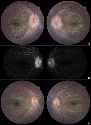 A. Fundus photograph one month after the start of immunosuppression: bilateral papillary edema with partial macular star in the left eye and scant macular exudates in the right eye. B. Fluorescein angiography: papillary hyperfluorescence with leakage in the arteriovenous time in BE. C. Fundus photograph 7 months after the start of immunosuppression: clear papilla with no macular exudates.