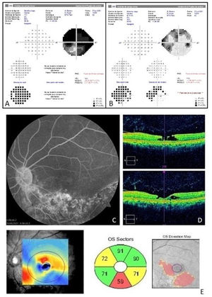 Unifocal and unilateral pigmented paravenous retinochoroidal atrophy ...