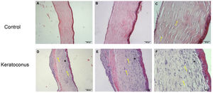 Morphological alterations after collagenase II administration. Morphological changes of corneas exposed to collagenase II show changes characteristic of an inflammatory and regenerative process and loss of integrity in Bowman's layer, compared to controls. (A–C) Controls. (D–F) Keratoconus. Both with 5×, 10× and 20× objectives, respectively (magnification 500, 1000 and 2000, scale bar 200μm, 100μm and 50μm, respectively).