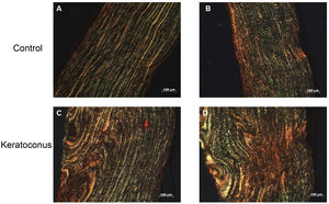 Collagen fiber change in keratoconus animal model. The alteration in corneal collagen fibers with collagenase II indicates a process of corneal stroma regeneration by the action of collagenase II, mainly collagen type I synthesis. (A–B) Controls. (D–E) Keratoconus. Both with 10× objectives (magnification 1000, scale bar 100μm).