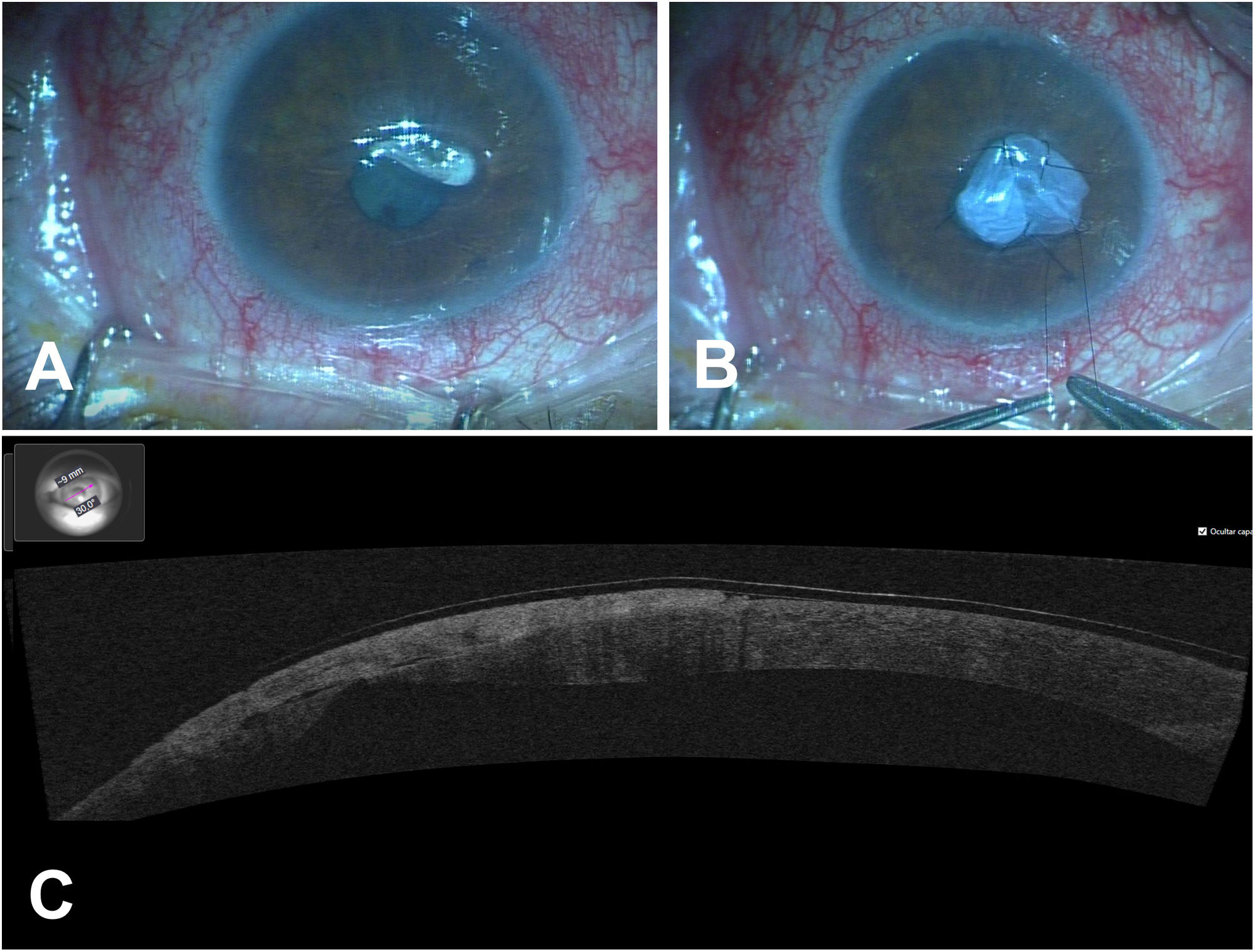 Anterior segment optical coherence tomography in a case of penetrating ...