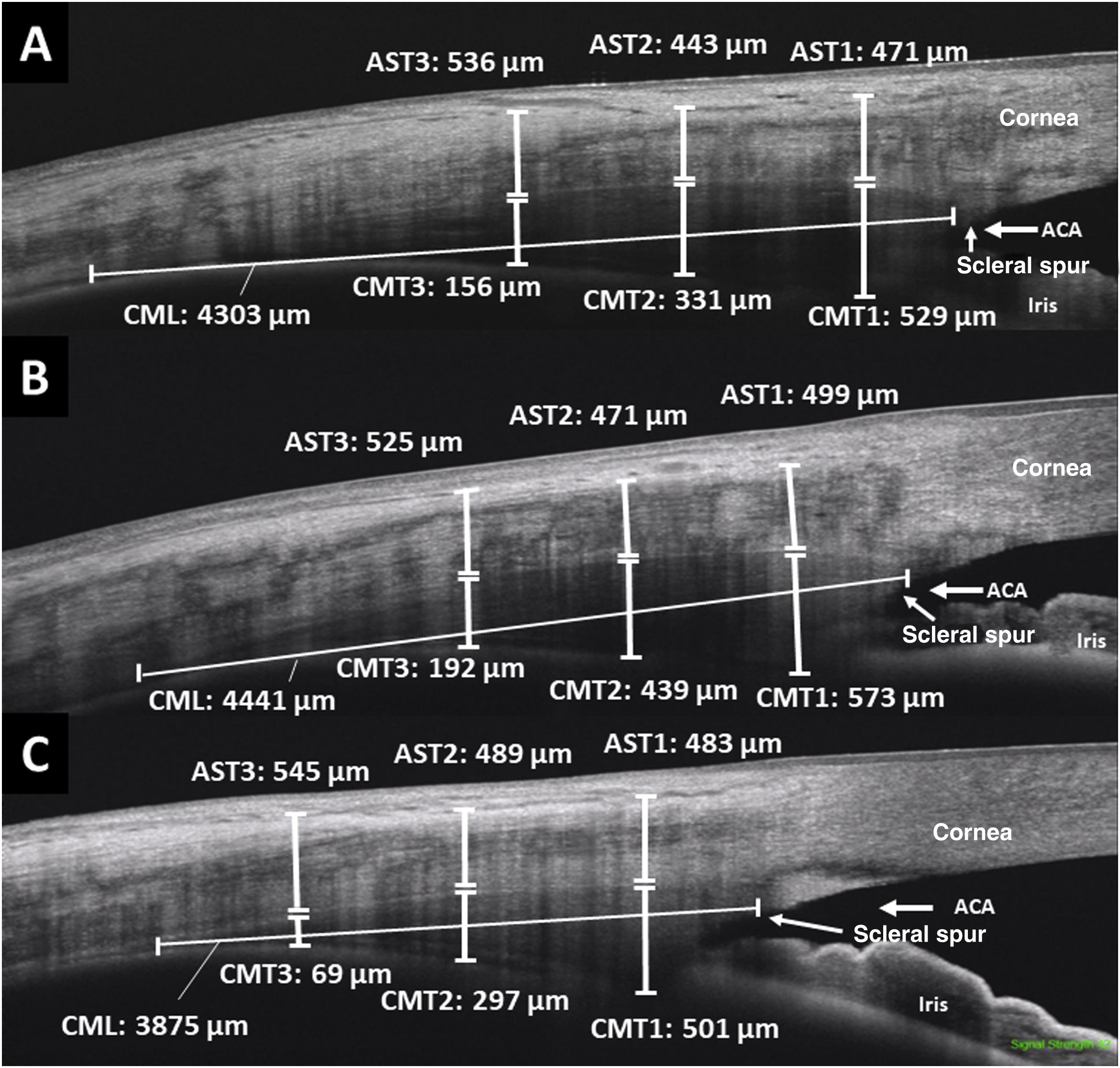 Icelus Hyperopes Assessment of the ciliary muscle and scleral anterior thickness in high ...