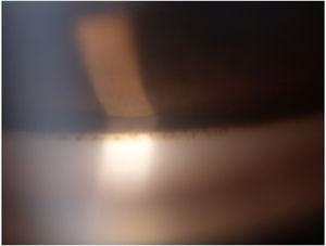 Gonioscopy under slit lamp showing pigment deposition in the chamber angle.