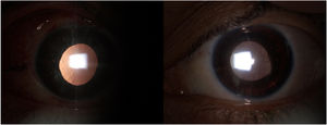 Slit lamp photographs showing dyscoria with moderate non-reactive mydriasis associated with bilateral iris transillumination in both eyes.
