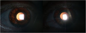 Slit lamp photograph showing bilateral iris transillumination in retro-illumination.