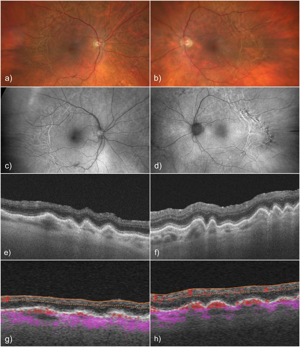 diagnosis-of-bilateral-idiopathic-choroidal-folds-by-funduscopy-oct