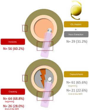 (A) First step of phacoemulsification to be learned. Incisions (main and paracentesis) are the most commonly cited, followed by lens implantation and viscoelastic removal. (B) Most difficult maneuver to learn. At the beginning of the residency, cracking was the most frequently cited. At the end of the residency, while both maneuvers are always perceived as complicated, the number of participants citing them is divided by three.
