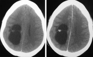 CAT without and with contrast corresponding to a cystic GG of parietal location (case 1).