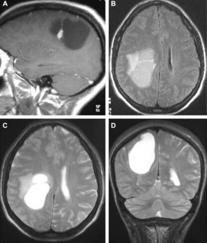 MRI corresponding to the same patient. (A) T1-weighted sequence with contrast. (B)–(D) T2-weighted sequences.